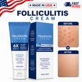Folliculitis Treatment Cream: Effective Treatment for Folliculitis Scalp,100g/1x