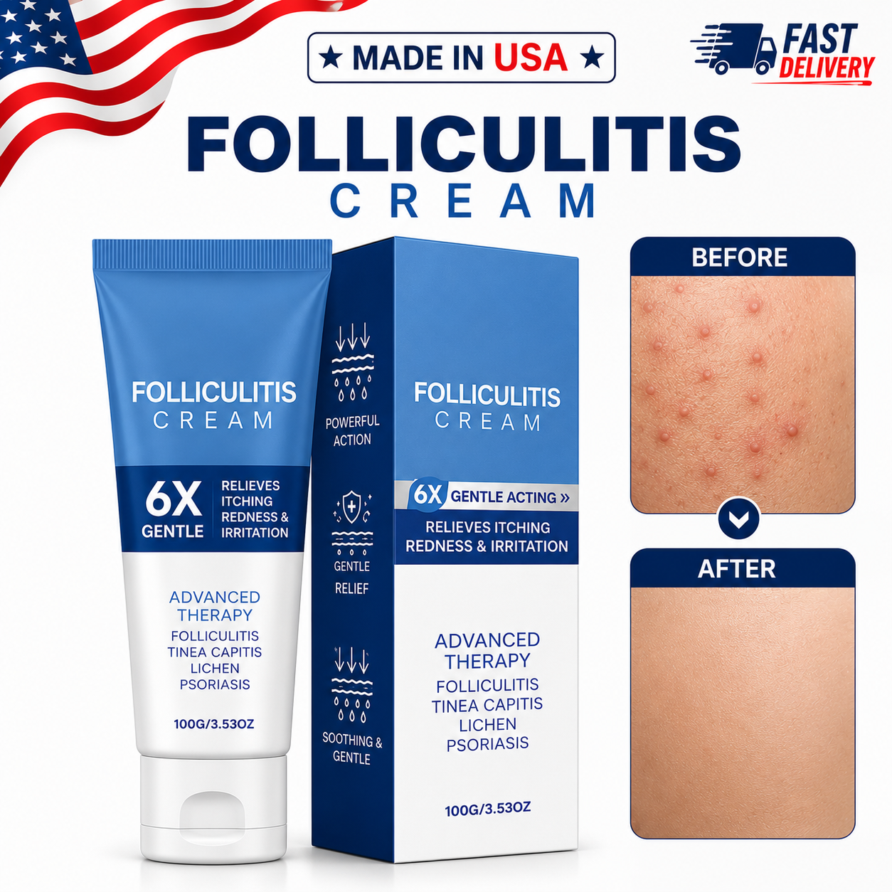 Folliculitis Treatment Cream: Effective Treatment for Folliculitis Scalp,100g/1x