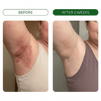 Restora™ Relief Cream - Skin Fold Rash Treatment