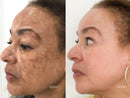 Spray- 577 Remove manchas de SOL, IDADE E MELASMA! 50% DE DESCONTO + FRETE GRÁTIS!