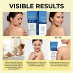 Folliculitis Treatment Cream: Effective Treatment for Folliculitis Scalp,100g/1x