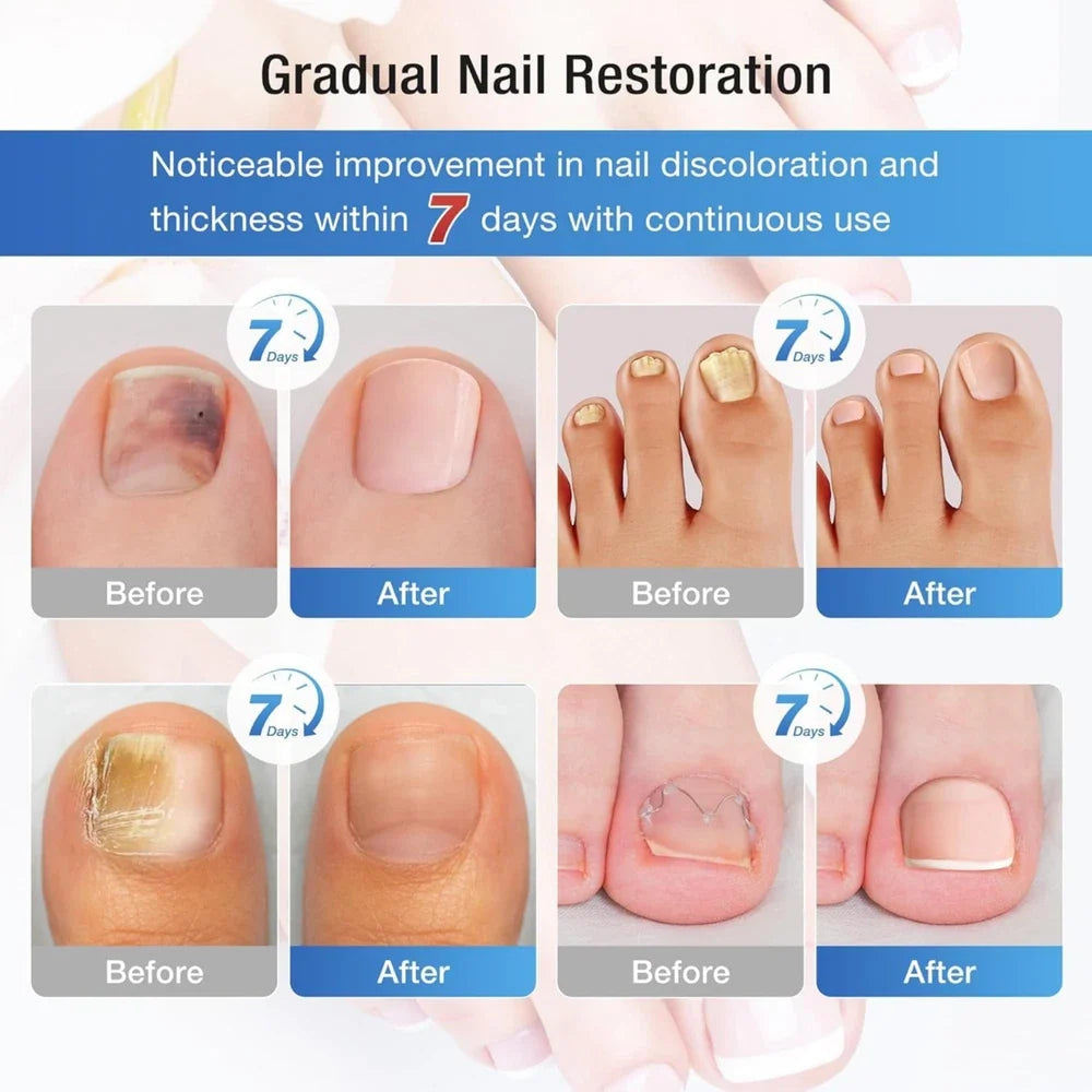 60 Pcs - Extra Strength Fungal Nail Patches, 60 Pcs Toenail Treatment for Nail Care
