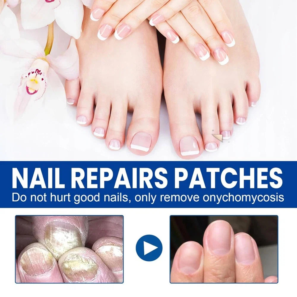 60 Pcs - Extra Strength Fungal Nail Patches, 60 Pcs Toenail Treatment for Nail Care
